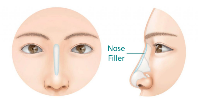 nose filler